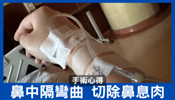 鼻中隔彎曲 切除鼻息肉 手術心得 - 理工宅